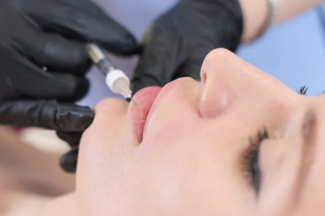 Lippenunterspritzung für Patientinnen aus Worms – natürlich, diskret & gut erreichbar