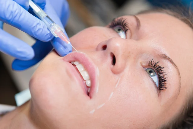 Faltenunterspritzung für Patientinnen aus Bürstadt – natürlich frischer aussehen
