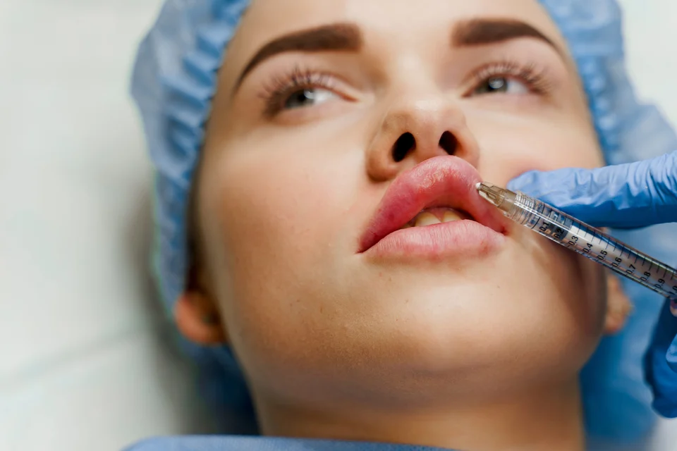 Wie lange hält Hyaluron in den Lippen wirklich?