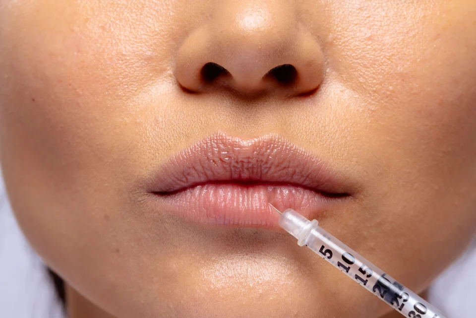 Risiken & Sicherheit bei der Lippenunterspritzung – was wirklich wichtig ist