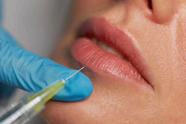 Lippenunterspritzung für Patientinnen aus Bürstadt – natürlich, ruhig & gut erreichbar