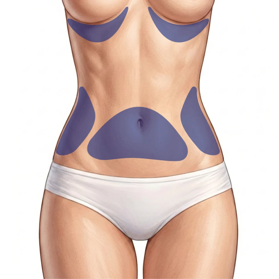 Fett-weg-Spritze am Bauch: Gezielte Fettreduktion in Lampertheim